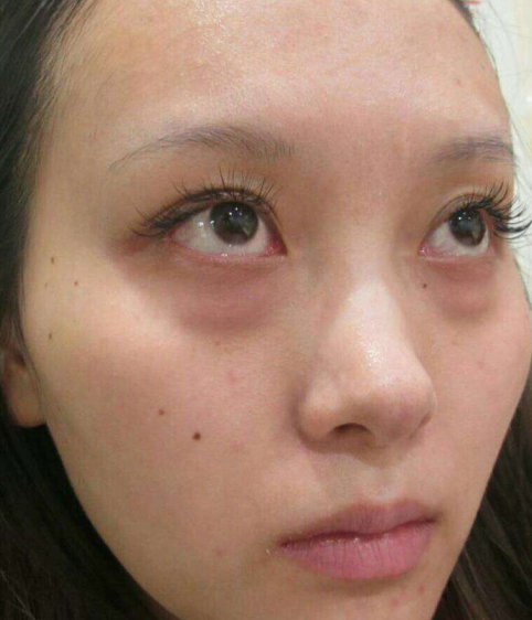去眼袋手术