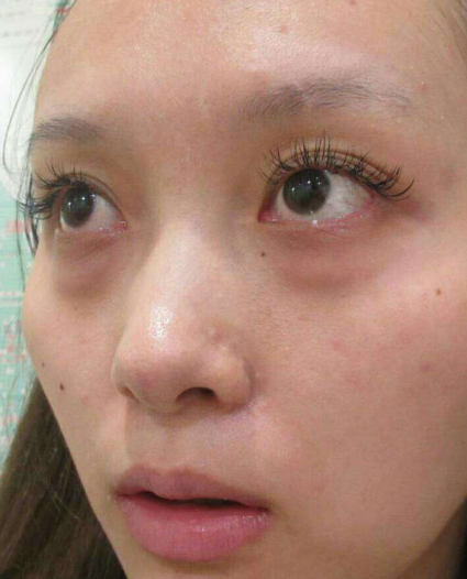 去眼袋手术