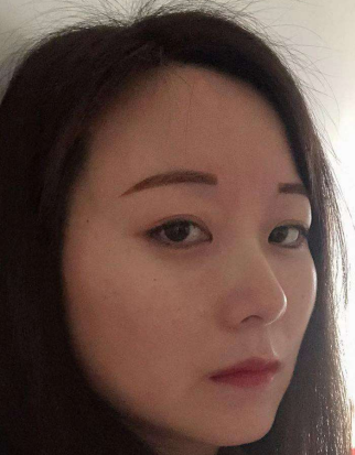 去眼袋手术