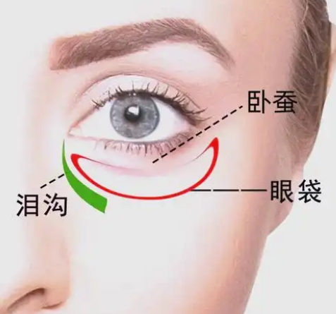 去眼袋手术