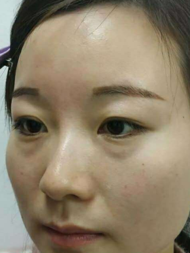 去眼袋手术