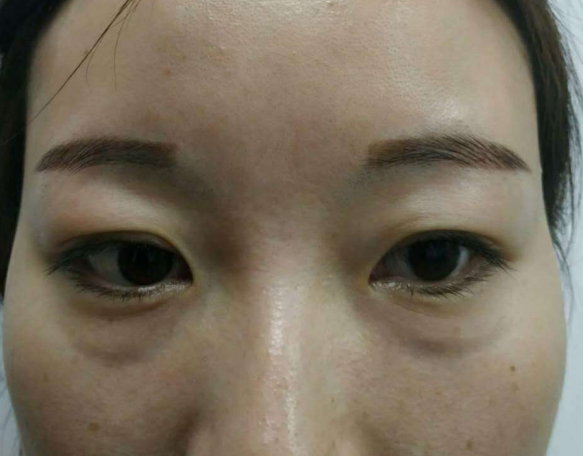 去眼袋手术