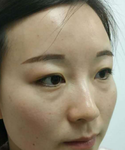 去眼袋手术