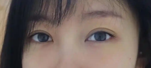 去眼袋手术