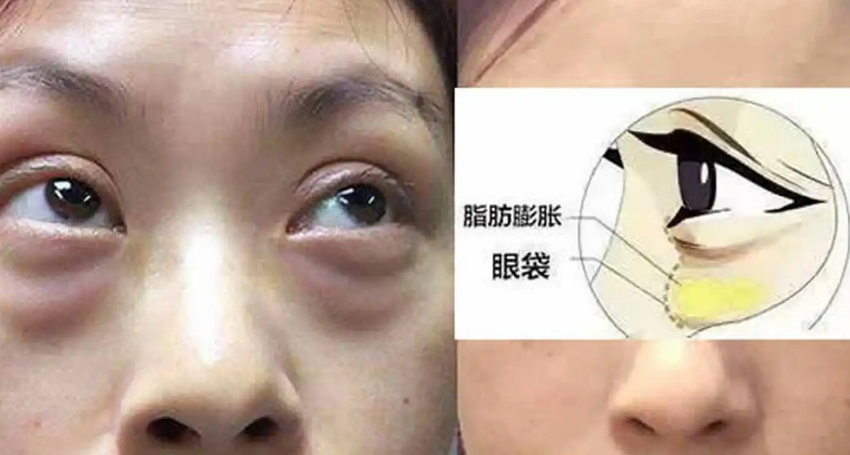去眼袋手术
