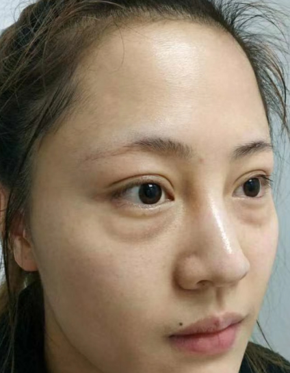 去眼袋手术