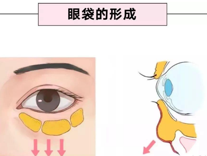 去眼袋手术