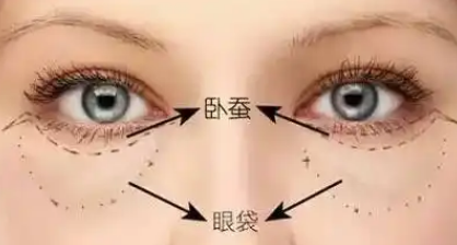 去眼袋手术