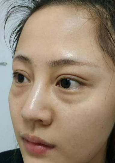 去眼袋手术