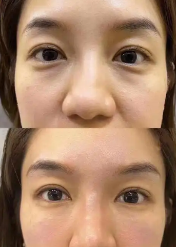 去眼袋手术