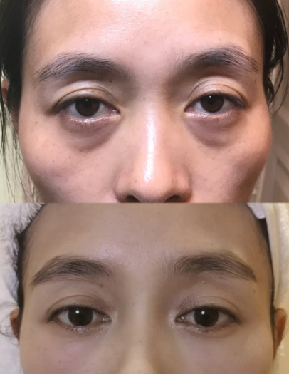 去眼袋手术