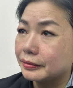 去眼袋手术
