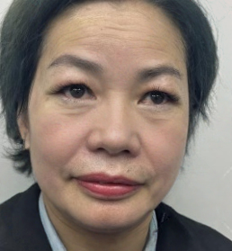 去眼袋手术