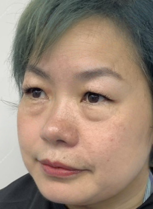 去眼袋手术