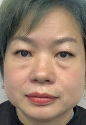 去眼袋手术