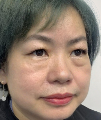 去眼袋手术