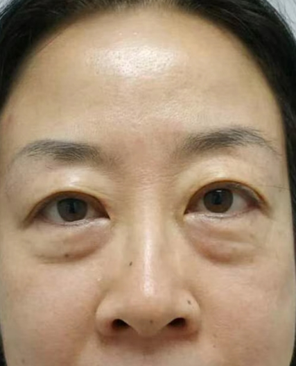 去眼袋手术