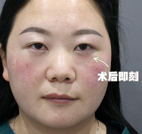 去眼袋手术