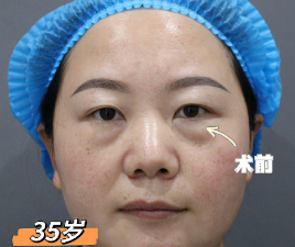 去眼袋手术