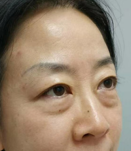 去眼袋手术