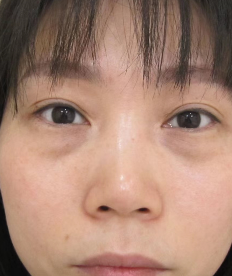 眼袋