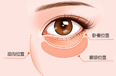 眼袋