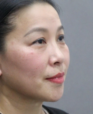 去眼袋手术