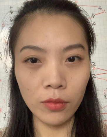 去眼袋手术