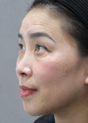 去眼袋手术