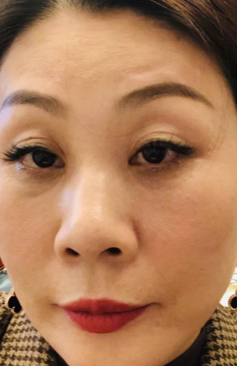 去眼袋手术