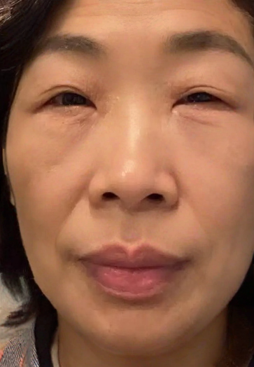 去眼袋手术