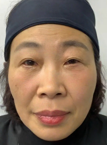 去眼袋手术