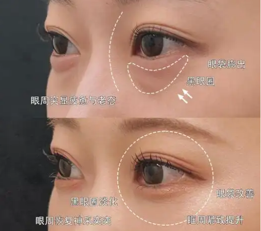 去眼袋手术
