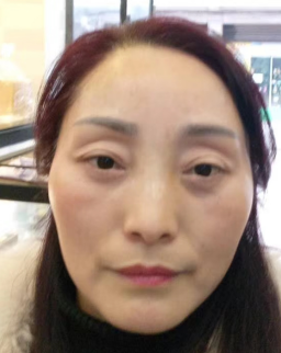 去眼袋手术