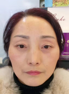去眼袋手术