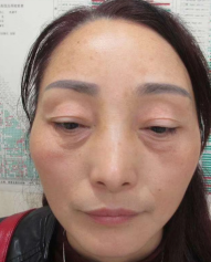 去眼袋手术