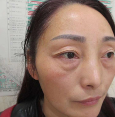 去眼袋手术