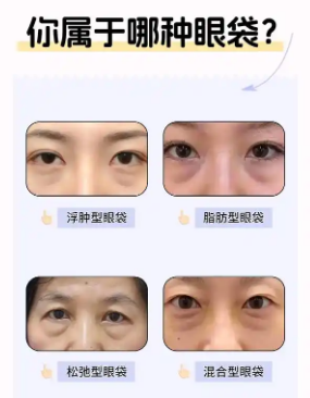 去眼袋手术