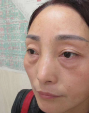 去眼袋手术