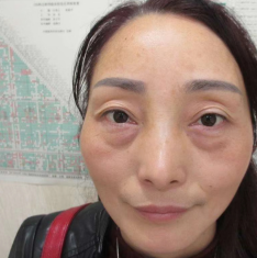 去眼袋手术