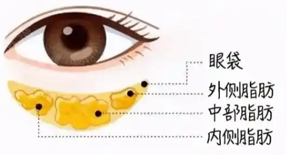 眼袋