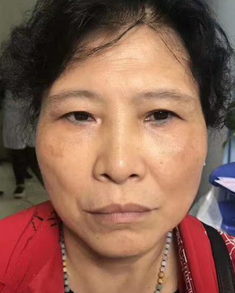 眼袋