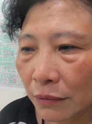 眼袋