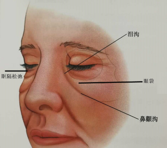 眼袋