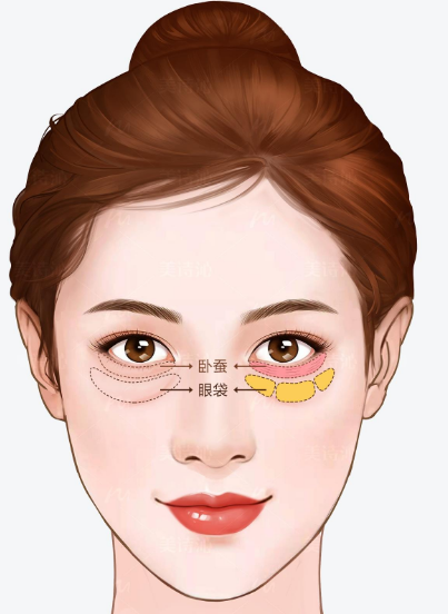 眼袋