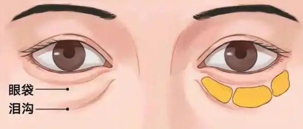 眼袋
