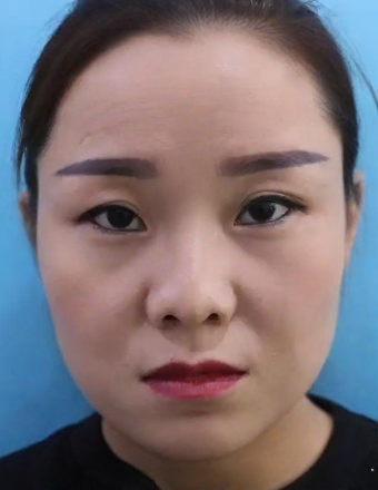 去眼袋手术