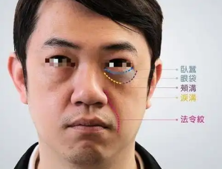 去眼袋手术