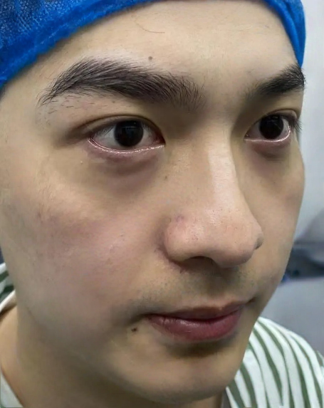 去眼袋手术