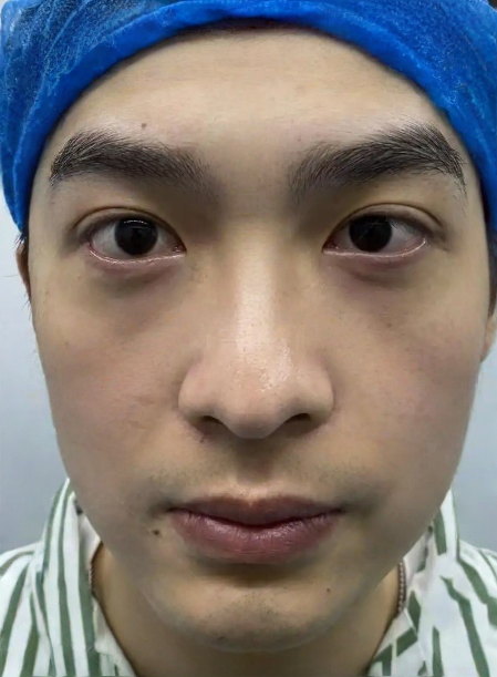 去眼袋手术